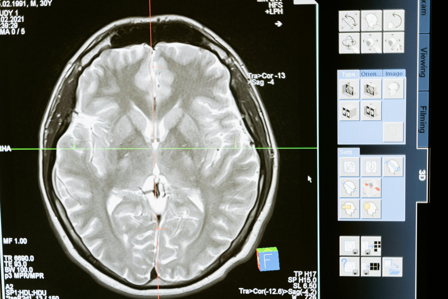 Simplified brain scans comparing the general characteristics of a brain with depressive symptoms to a healthy brain when performing a cognitive task.