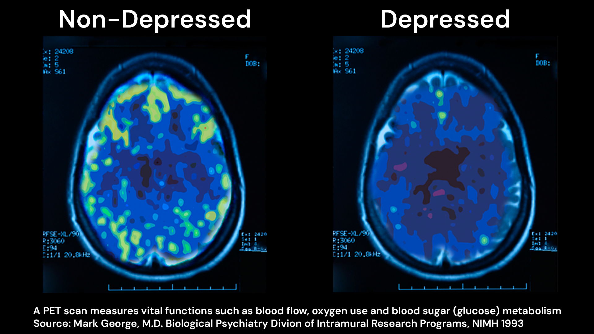Simplified brain scans comparing the general characteristics of a brain with depressive symptoms to a healthy brain when performing a cognitive task.